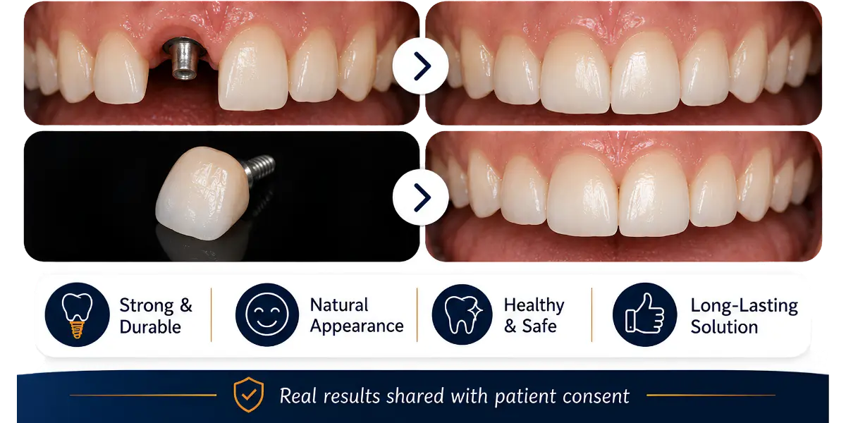 Implant crown — natural-looking result