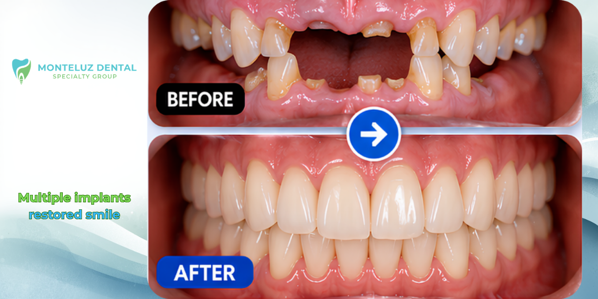 Multiple implants — restored smile
