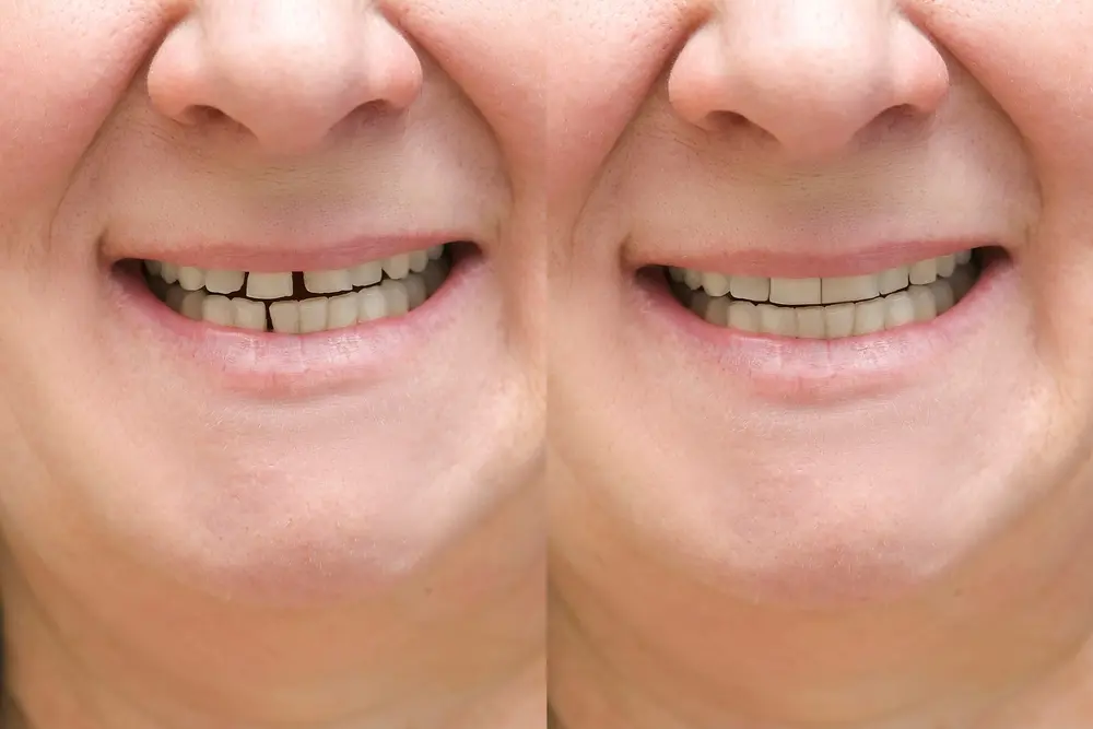 Chipped front tooth repair before and after