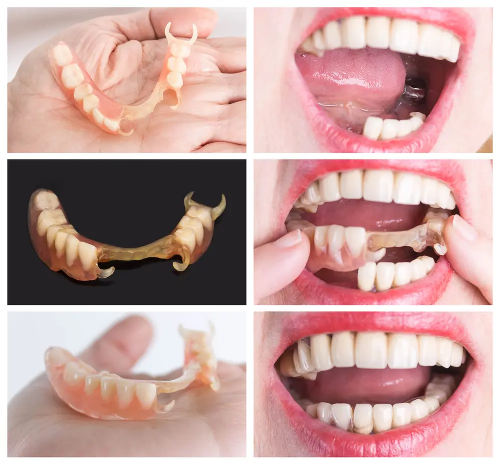 Flexible partial dentures, multiple views