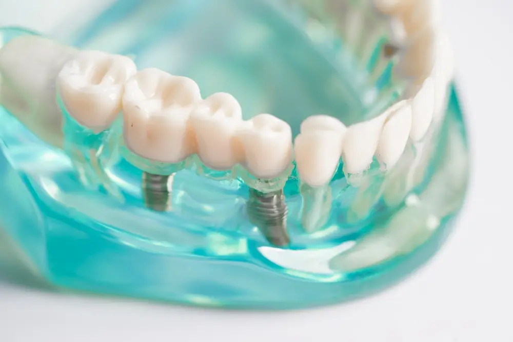 Dental Implant Aftercare for Optimal Healing