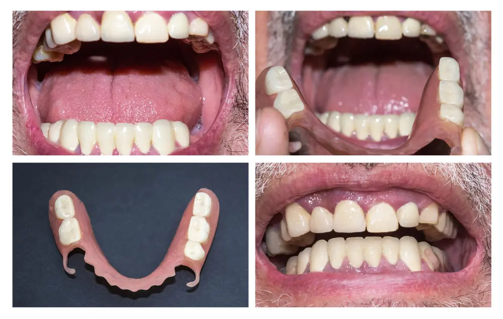 Partial denture restoration, four views