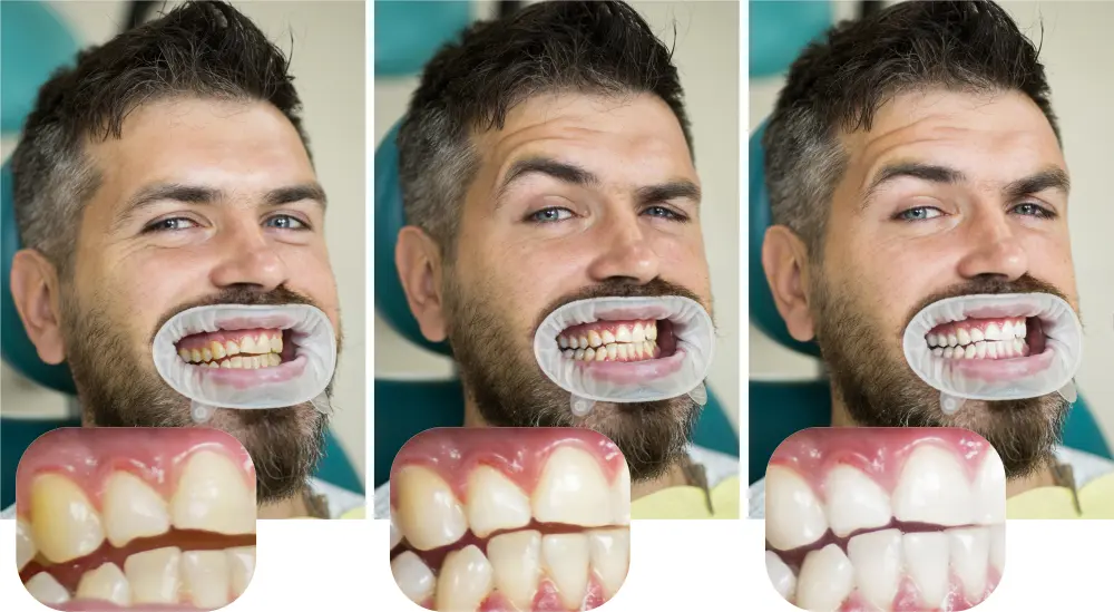 Teeth whitening progression in three stages